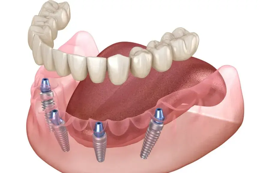 Featured image for “Average Cost of All-On-4 Dental Implants”