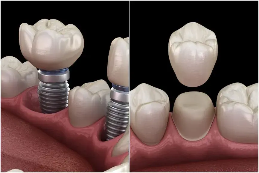 Featured image for “Dental Implants vs. Crowns: Which is Right for You?”