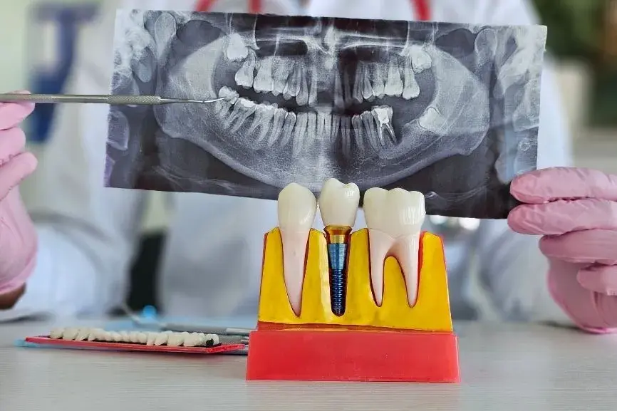 Featured image for “How Do Dental Implants Work?”