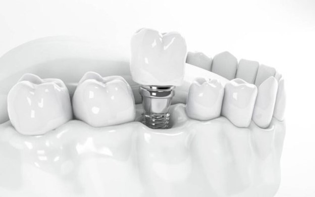 Featured image for “What Are All On 4 Dental Implants”