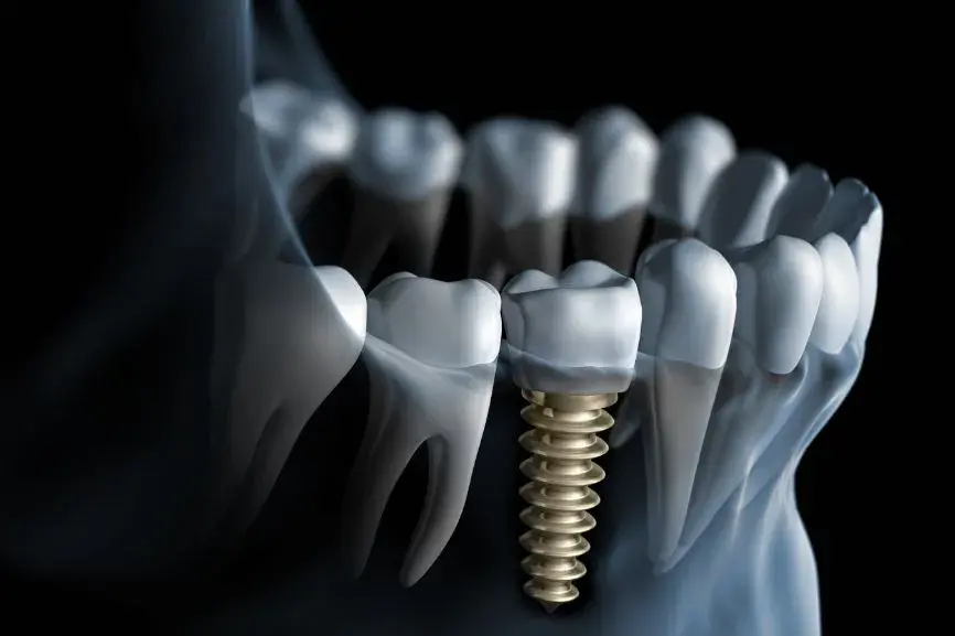 Featured image for “What Do Dental Implants Look Like?”