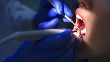 Misconceptions and Myths About Root Canals
