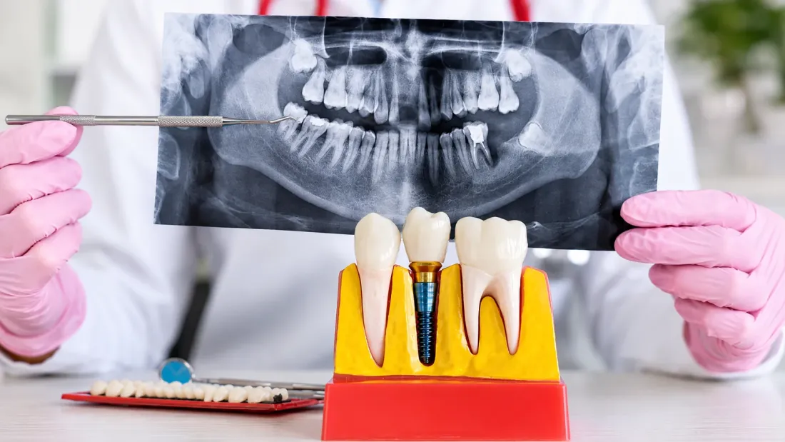 How Do Dental Implants Work?