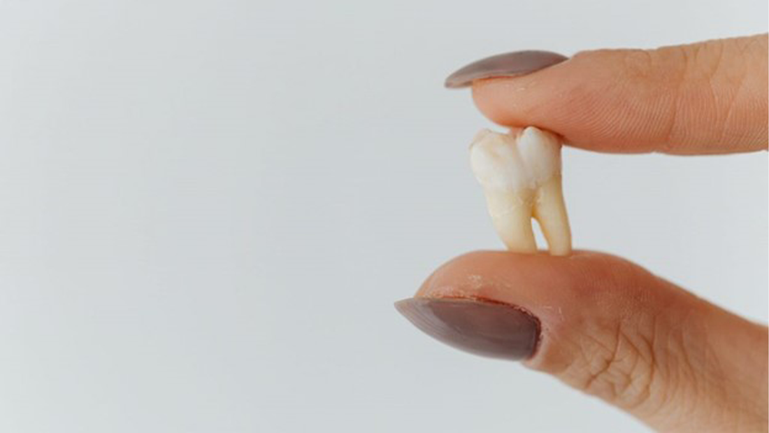 How to Fix a Chipped Tooth