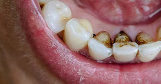 Tartar buildup on teeth near the gumline