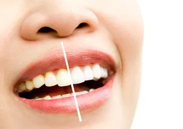 Top Foods and Drinks That Stain Your Teeth
