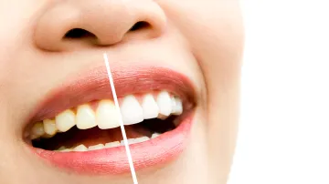 Top Foods and Drinks That Stain Your Teeth