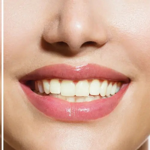 Virtual teeth whitening smile preview