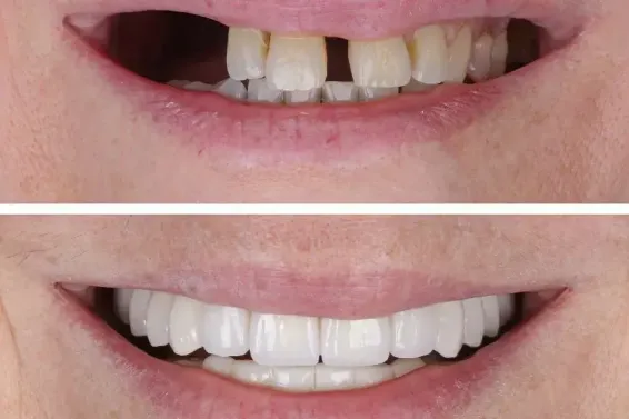 Featured image for “All-On-4 Dental Implant Procedure”