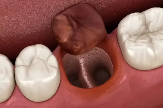 Featured image for “How to Prevent Dry Socket?”