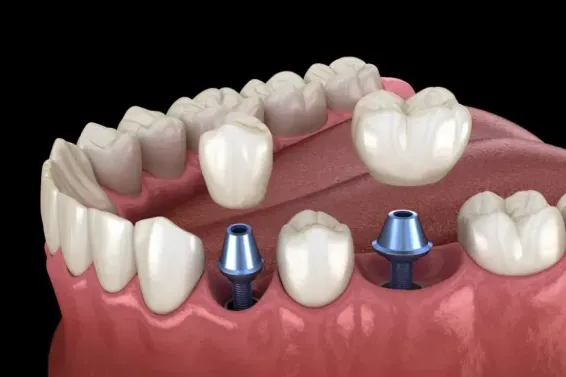 Featured image for “Same Day Dental Crowns: The Benefits of Speedy Restoration”