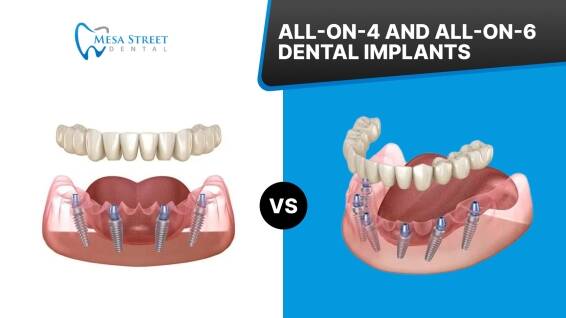 Featured image for “All-on-4 vs All-on-6: What’s the Difference?”