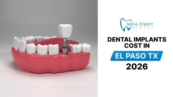 Featured image for “Dental Implants Cost in El Paso TX 2026”