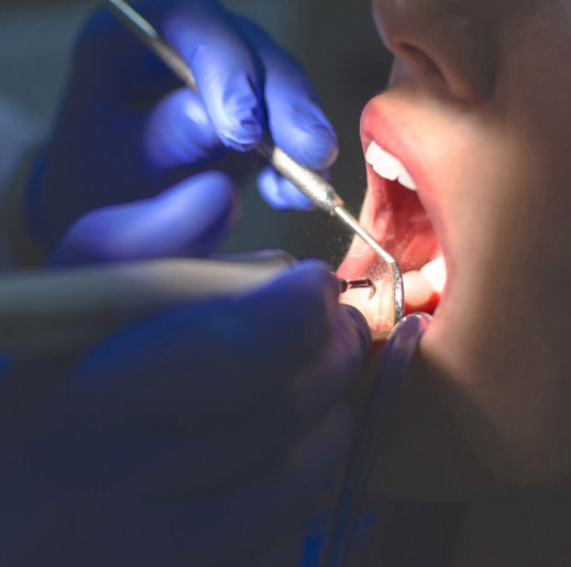 Patient opening their mouth for a root canal treatment at a dental office