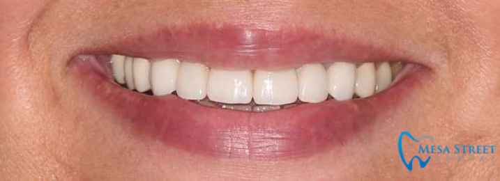 Crowns and Veneers to Correct Shade After