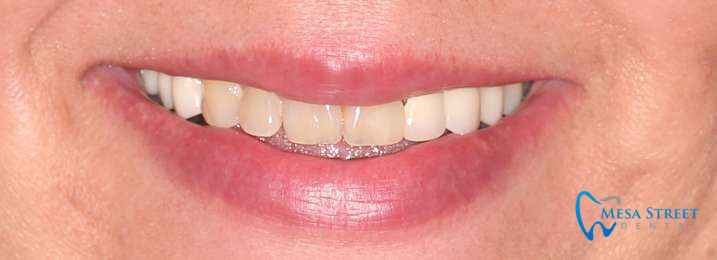 Crowns and Veneers to Correct Shade Before