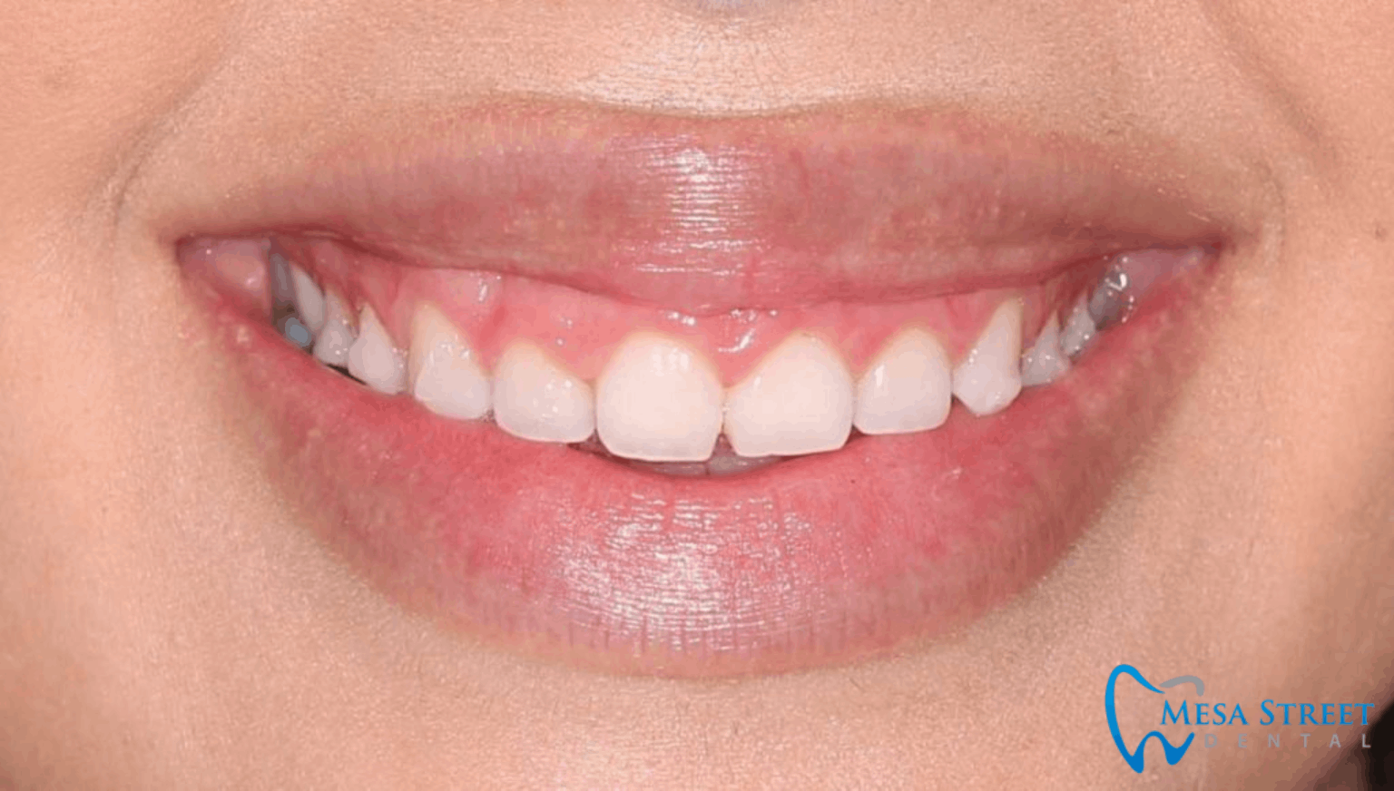 Gummy Smile Before Crown Lengthening Surgery