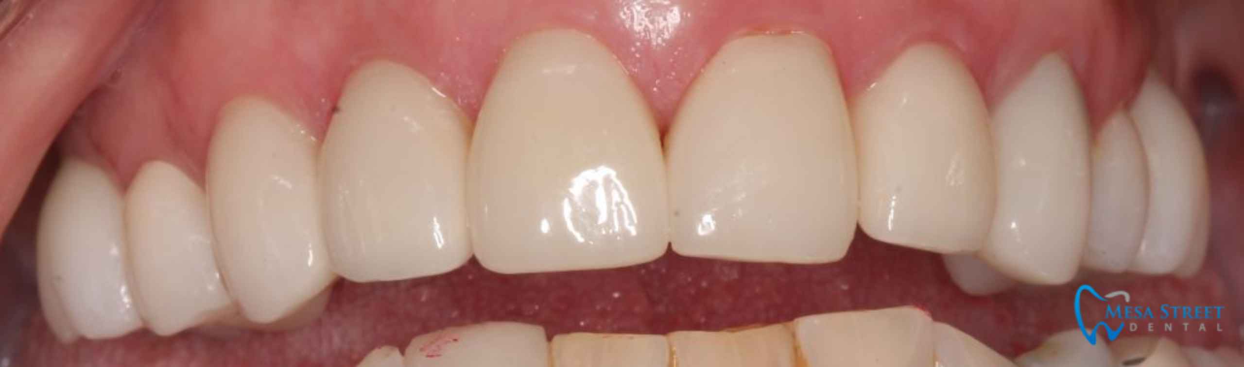 Crowns and Implants Correcting Damaged Teeth