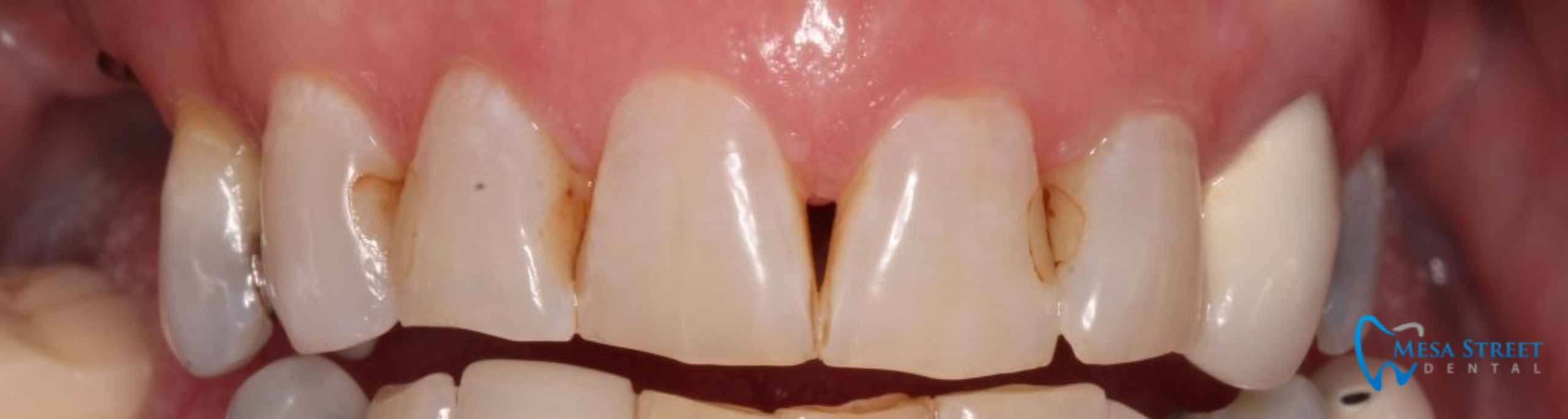 Teeth Before Crowns and Implants