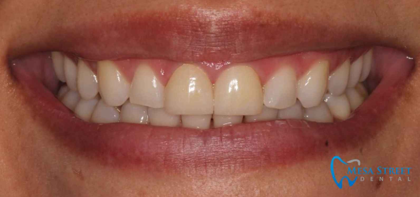 Veneers and Crowns to Correct Shade Before
