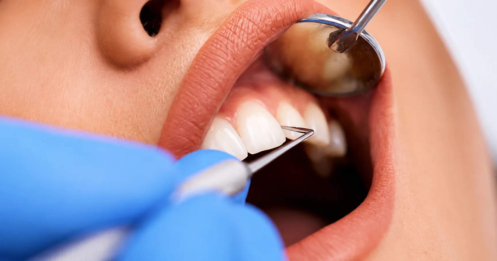 Root Canal Treatment in El Paso, TX I