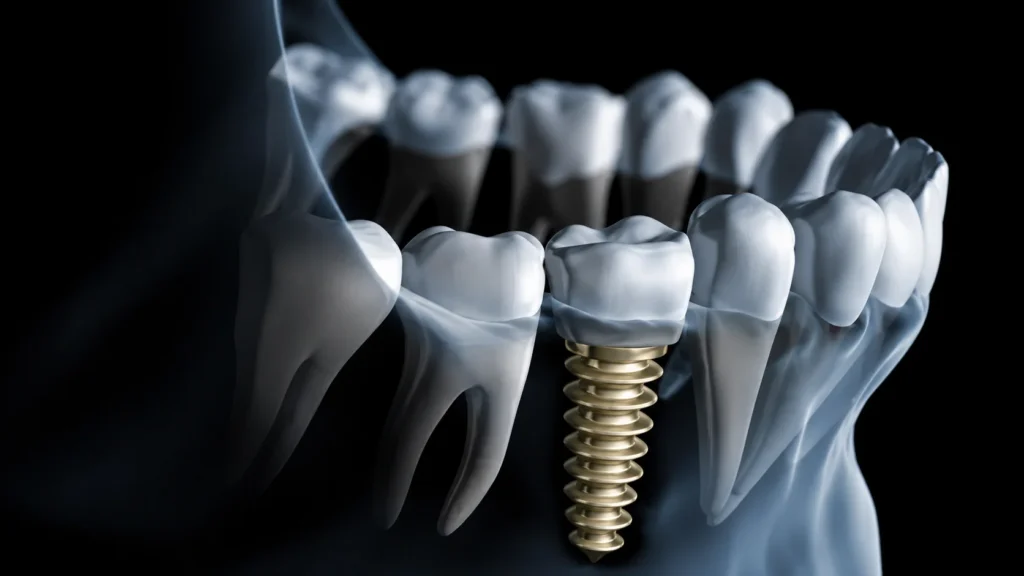 What Do Dental Implants Look Like? What Do Dental Implants Look Like?