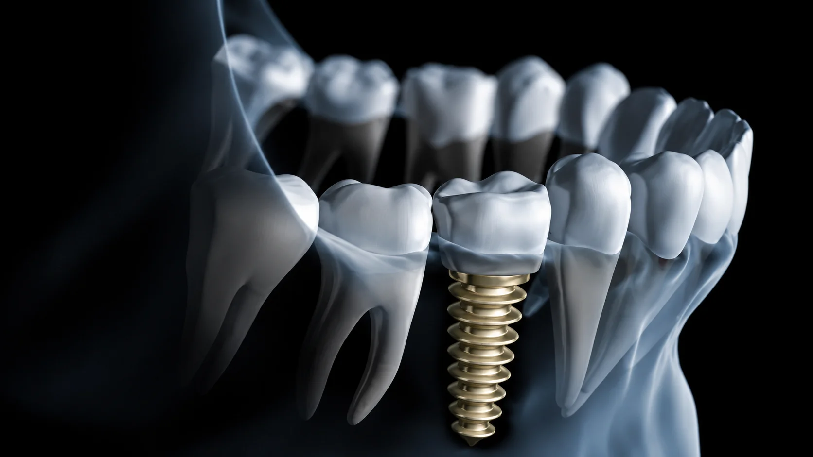 What Do Dental Implants Look Like? What Do Dental Implants Look Like?