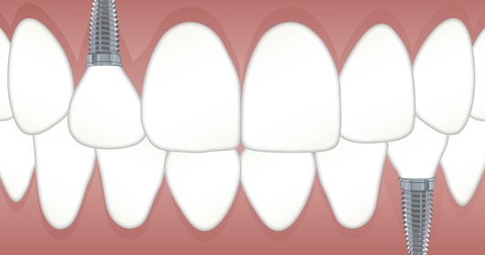 Dental Implants in El Paso, TX