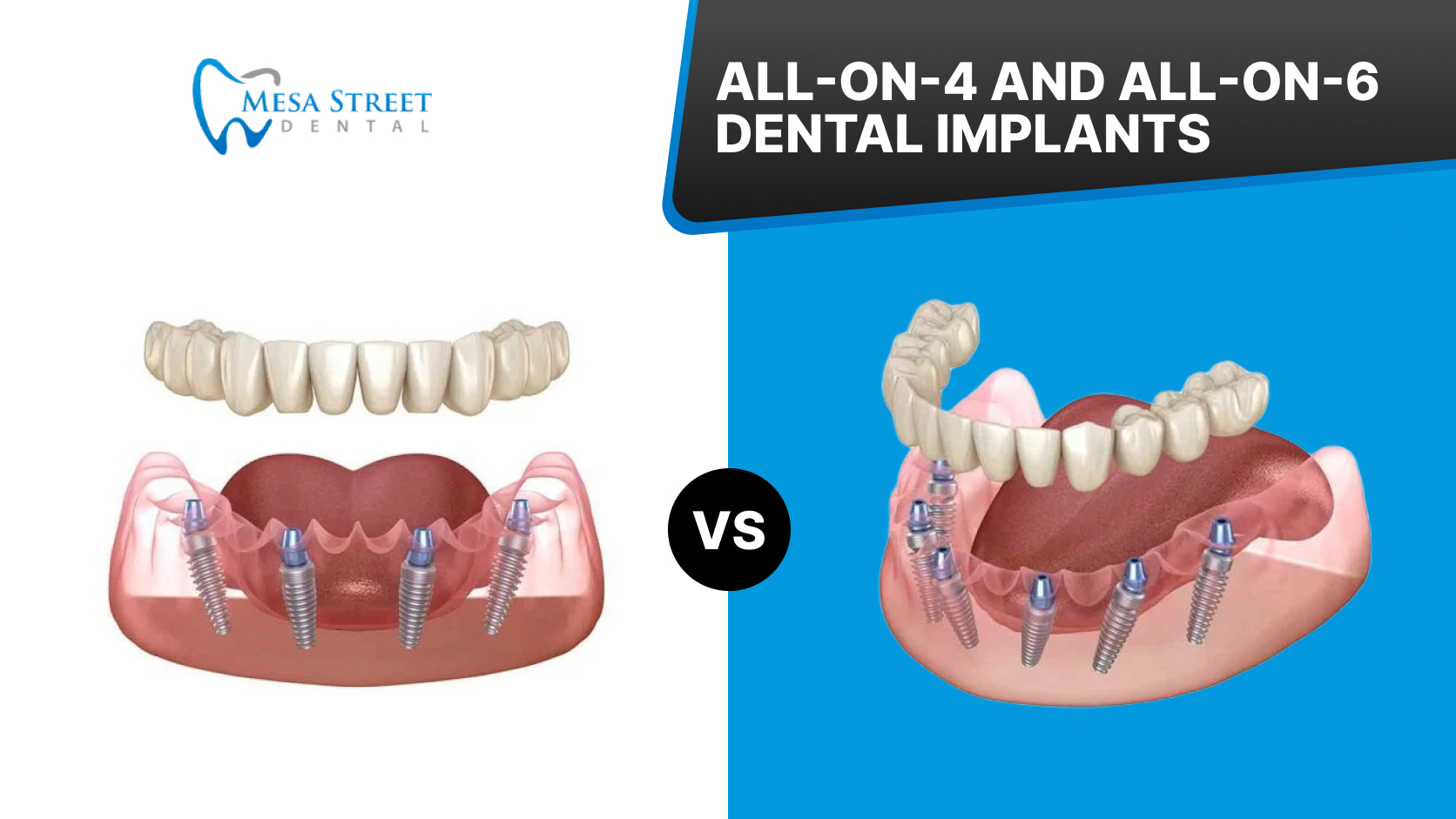 Featured image for “All-on-4 vs All-on-6: What’s the Difference?”