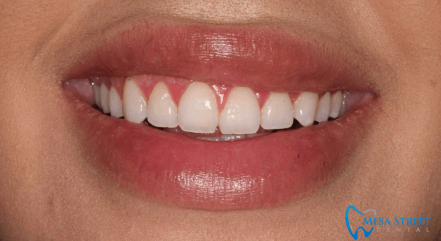 Gummy Smile After Crown Lengthening Surgery