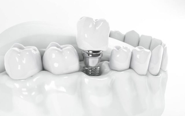 dental-implants-looklike